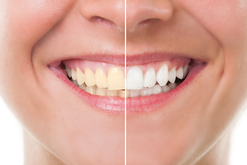 Teeth Whitening - Bella Dental Services, La Puente Dentist